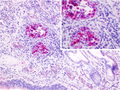 Figure 6. Lung. Male sea lion (245513). intranuclear and intracytoplasmic staining for Influenza A nucleoprotein in peribronchial inflammatory cells and cell debris in peri-bronchial glandular area. IHC against Influenza A nucleoprotein, 20×. Inset: magnification of the positive immunostaining. 60×.