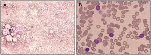 Figure 2. Bone marrow aspiration showed hypo-cellular marrow.