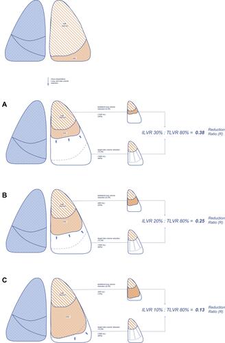 Figure 1 Schematic illustration of the assumed pathophysiology showing examples of the same target lobe volume reduction (TLVR in %) Display full size in relationship to different ipsilateral lung volume reductions (ILVR in %) Display full size for the calculation of the Reduction Ratio (R).