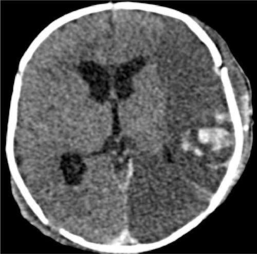 Figure 1 Post craniotomy axial CT shows extensive hypodensity involving the gray and white matter of the left hemisphere with bleeding foci. Midline shift and uncal herniation is also seen.