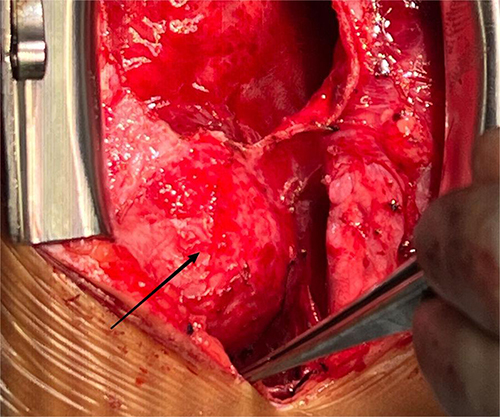 Figure 6 Intraoperative photograph showing a large tumor-like protrusion on the left anterior wall of the ascending aorta. Arrow: a large tumor-like protrusion.