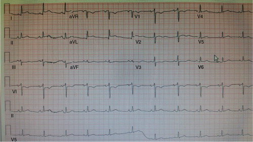 Fig. 5 12 lead EKG.