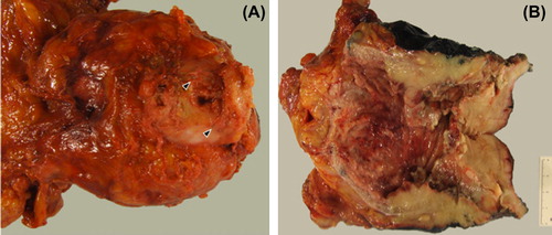 Figure 1. Macroscopic performance of prostatic sarcoma. (A) Black arrows show brachytherapy implants into the prostate tissue. (B) Sectional profile of excised specimen. Prostate is replaced by grayish tumor tissue, which extended into the bladder wall.