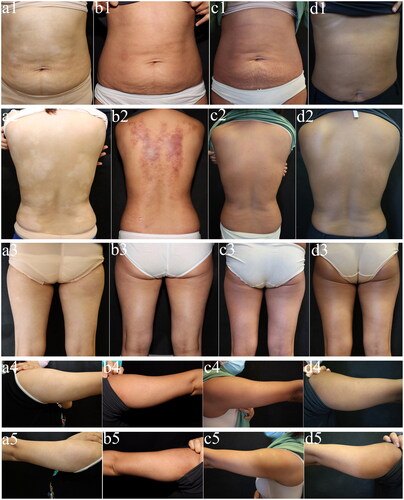 Figure 4. Changes in skin lesions on the abdomen, back, thighs, and upper arms from before to after treatment in Patient 18. (a1–a5) Before treatment. (b1–b5) One month after starting treatment. (c1–c5) Three months after starting treatment. (d1–d5) Six months after starting treatment.