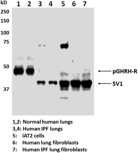 Figure 4. Expression of GHRH-R in lung tissues and iAT2 cells. Western blotting was done to confirm protein expression of the GHRH receptor in lung tissues and iAT2 cells. The full-length pituitary type GHRH-R (pGHRH-R) was predominantly expressed in normal lungs, while the truncated splice variant 1 (SV1) was expressed strongly in lungs from patients with IPF, as well as in cultured iAT2 cells, normal lung fibroblasts and fibroblasts isolated from patients with IPF.