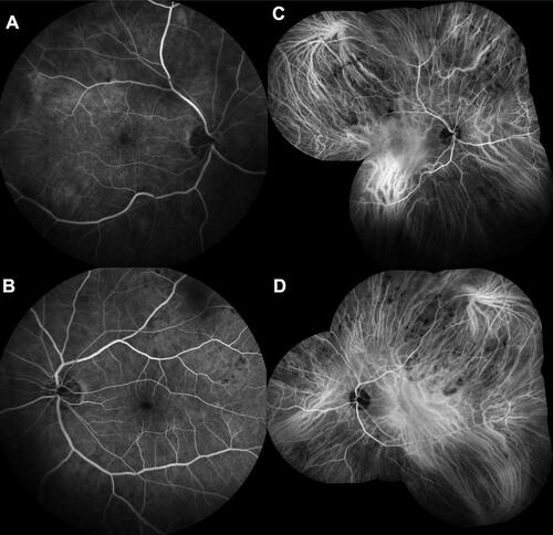 Figure 3 Fluorescein angiography of right (A) and left (B) eyes displays mild-moderate late phase staining with no obvious leakage. Indocyanine green angiography (ICGA) of right (C) and left (D) eyes shows extensive, multifocal hypofluorescent lesions in the near-peripheral and mid-peripheral fundus with choroidal vascular hyperpermeability of the macular area.