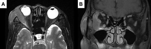 Figure 2 The magnetic resonance imaging of the orbit. (A) Axial T2-weighted post-contrast images showed a mildly enhanced mass compressing the adjacent right lateral rectus muscle and the globe. (B) Coronal T2-weighted post-contrast images showed an extra-conal lesion, which was well-defined and iso-intense as the lateral rectus muscle. 