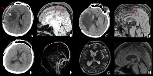 Figure 3 Case 2: (A) Brain CT on admission indicated new cerebral hemorrhagic infarction in the right frontoparietotemporal lobe with obvious local edema and right cerebral hernia. (B) MRBTI on admission displayed superior sagittal sinus thrombosis. (C) After methylprednisolone therapy, compared with A, brain CT demonstrated that the edema and hemorrhage area of the right frontoparietotemporal lobe were significantly reduced and the left shift of midline structure alleviated. (D) After methylprednisolone therapy, compared with (B), MRBTI showed the thrombus in superior sagittal sinus was reduced. (E) At 3-month follow-up, compared with (C), brain CT showed the edema of the right frontoparietotemporal lobe disappeared and only a few previous infarcts remained. (F) At 3-month follow-up, CE-MRV indicated a considerable decrease of thrombus in the superior sagittal sinus without new thrombosis in comparison to (D). (G) At 6-month follow-up, compared with (E), Axial T2-MRI revealed no significant changes in right frontoparietotemporal lobe and no new infarcts were detected. (H) At 6-month follow-up, MRBTI demonstrated a further reduction of superior sagittal sinus thrombus compared to (F), leaving a negligible quantity of residual thrombus.
