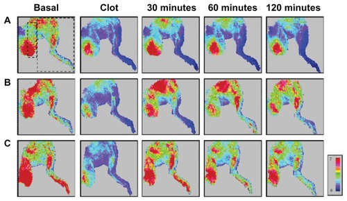 Figure 7 Representative results of the effects of MNC-rtPA on tissue perfusion in a rat embolism model. The tissue perfusion of the hind limb and cremaster area was measured with a laser Doppler perfusion imager. Five minutes after clot lodging, MNCs (1.1 mg/kg) with (B and C) or without (A) MNC-rtPA (0.2 mg/kg) were administered from the right iliac artery under magnetic guidance. Laser Doppler signals in the designated areas, as illustrated with the squares in (A), were acquired for the quantitative analysis of hind limb versus cremaster perfusion.Abbreviations: MNC, magnetic nanocarrier; rtPA, recombinant tissue plasminogen activator.