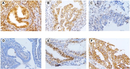 Figure 3 Immunohistochemical staining of PHD2 in endometrial tissues. (A) High expression of PHD2 in normal endometrium (×400); (B) moderate expression of PHD2 in atypical endometrial hyperplasia (×400); (C) low expression of PHD2 in endometrial cancer (×400); (D) low expression of HIF-1α in normal endometrium (×400); (E) moderate expression of HIF-1α in atypical endometrial hyperplasia (×400); (F) high expression of HIF-1α in endometrial cancer (×400).