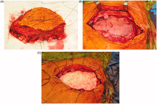 Figure 4. Intraoperative images of the resected sternal body incorporating the major pectoral muscles (A), the large defect of the anterior chest wall after resection (B), sternal reconstruction by a methyl methacrylate sandwich graft (C).