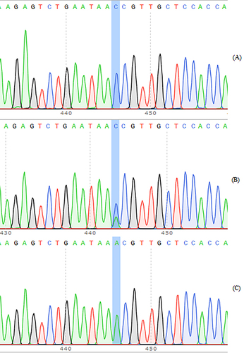Figure 3 PCR products were sequenced for rs76863441 loci of PLA2G7 gene polymorphism (reverse sequencing). (A) rs76863441-G/G; (B) rs76863441-G/T; (C) rs76863441-T/T.