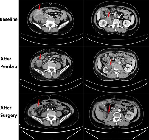 Figure 2 The intestinal and kidney mass treatment effect images of patient at baseline, after pembrolizumab and after surgery, respectively. The red arrow indicates the lesion.