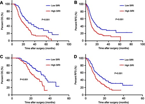 Figure 4 Prognostic significance of SIRI in PDAC patients who received postoperative adjuvant chemotherapy. Kaplan-‒Meier survival curves of OS and RFS stratified by SIRI in the training cohort (A, B) and validation cohort (C,).Abbreviations: SIRI, systemic inflammation response index; PDAC, pancreatic ductal adenocarcinoma; OS, overall survival; RFS, recurrence-free survival.