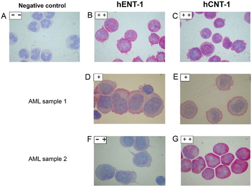 Figure 1. Immunocytochemistry for hENT1 and hCNT1 proteins, as scored by two independent observers in several representative patient samples. Negative control in HL-60 cells was done by omitting one antibody (1 A). Positive controls (1B, 1C) are compared with AML samples of different color intensity (1 D, E, F, G). Low staining was defined as less than one third of the intensity (<0.3) and high staining was defined as the upper fifth of the intensity (>0.8) and medium staining was in between these two intensities (- +).