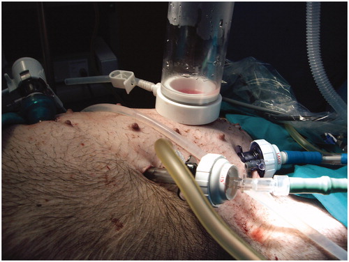 Figure 2. Closed-abdomen laparoscopic HIPEC by CO2 recirculation. Pig model.
