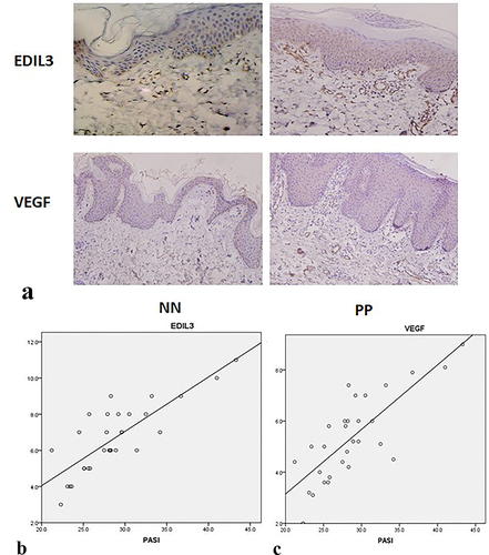 Figure 1 Results of immunohistochemical assay. EDIL3 and VEGF expression levels were upregulated in psoriatic skin lesions and were correlated with the PASI. (a) EDIL3 and VEGF expression levels in psoriatic skin lesions (PP) and normal skin (NN) were determined by immunohistochemical assay using antibodies against EDIL3 and VEGF. The brown section of the photomicrographs indicates the positive expression of EDIL3 or VEGF (magnification: 20×). (b) EDIL3 overexpression in psoriatic skin lesions was positively correlated with the PASI (p < 0.05, r = 0.811). (c) VEGF overexpression in psoriatic skin lesions was positively correlated with PASI (p < 0.05, r = 0.0784).