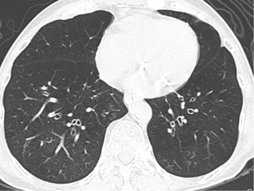 Figure 5 Axial CT image with a lung-window setting showing emphysema and bronchial wall thickening in bilateral lower lobes.Abbreviation: CT, computed tomography.