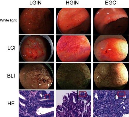 Figure 1 The representative white light, LCI, BLI and H&E histological sections of LGIN, HGIN, and EGC.Abbreviations: BLI, Blue Laser Imaging; EGC, early-stage gastric cancer; HGIN, High-grade Intraepithelial neoplasia, LCI, Linked Color Imaging; LGIN, Low-grade Intraepithelial neoplasia.