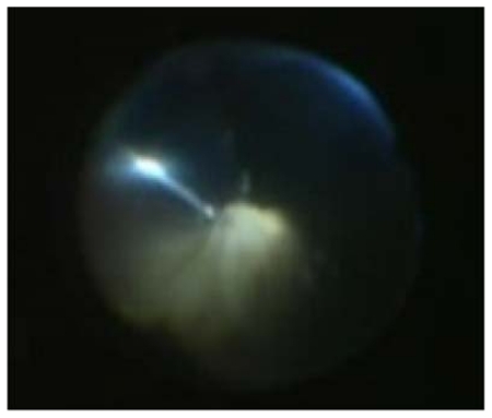 Figure 2 Dense vitreous opacity was removed with a wide-angle viewing system through the clearer inferior-temporal portion of the cornea.