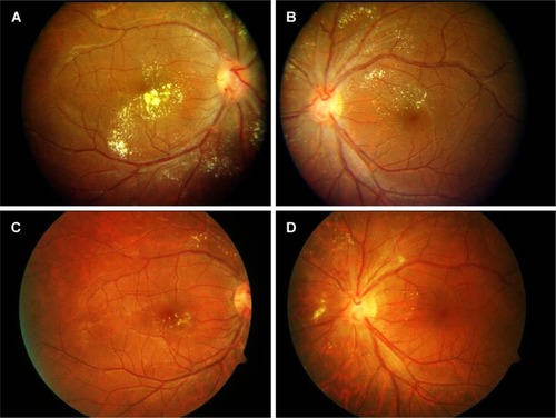 Figure 2 Fundus photography of eyes of 12-year-old male.