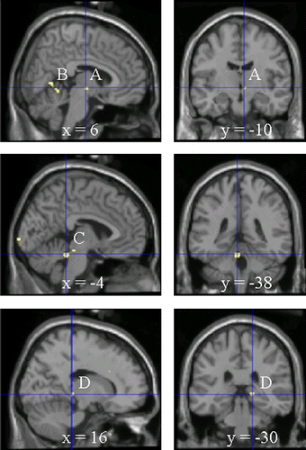 Figure 4  Differences in activated brain regions between 5HTTLPR genotypes during the arithmetic task. Activated brain regions were identified by PET and by subtraction of SS from SL + LL values (p < 0.001, uncorrected). A, hypothalamus; B, cerebellum; C, midbrain; D, pulvinar. See Table II for statistical analysis.