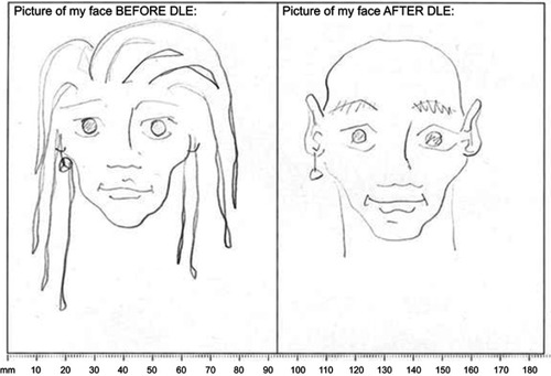 Figure 3 The patient’s perception of their face before and after their diagnosis of discoid lupus erythematosus.