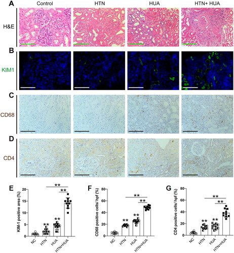 Figure 3. Hypertension and HUA jointly promote renal inflammation. ((A) representative micrographs show kidney morphology by H&E staining; (B,E) expression level of kidney injury marker KIM-1 is increased in hypertensive patient and hyperuricemia patients, compared to the control group, which was further increased in patients who developed both hypertension and hyperuricemia; (C,F) immunohistochemical staining revealed an increased infiltration of CD68+ macrophage; (D,G) CD4+ T cells in kidney of hyperuricemia patient and HTN patient, respectively, compared to the control group). And were further increased in patients who developed both HTN and HUA. 10 randomly selected fields of each kidney were counted, data are presented as mean ± SD from 10 patients per group, ** p < .010.