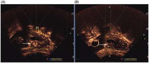 Figure 2. Contrast-enhanced ultrasound obtained from a patient treated with HIFU. A, abundant blood supply in myometrium of CSP scar (white arrow) around gestational sac before HIFU ablation; B, significantly reduced blood supply in myometrium of CSP scar (white arrow) around gestational sac after HIFU ablation.