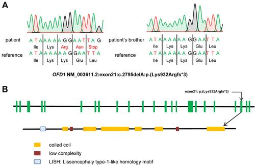Figure 2 (A) The result of Sanger sequencing of our proband and his brother. The variant c.2795delA:p.(Lys932Argfs*3) was found by whole-exome sequencing and validated by Sanger sequencing in our proband. (B) Structure of the OFD1 gene and protein.