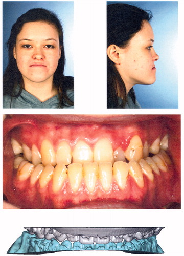 Figure 5. Top row: Preoperative situation in patient 3, a young female with skeletal class III malocclusion due to maxillary hypoplasia. Middle row: Intraoral situation before surgery and after orthodontic treatment. Bottom row: Intended virtual occlusal situation after two-jaw surgery.