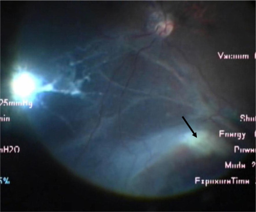 Figure 1 Intraoperative view using the wide-angle viewing system.