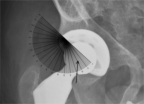 Figure 4. We use an ordinary goniometer to measure acetabular radiographic version directly. In this example, the goniometer is aligned with the long axis of the ellipse (the metal ring) and Wan's angle is then read on the middle point of the ellipse (arrow).