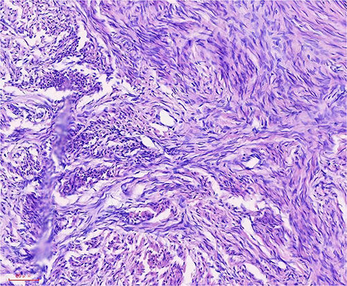 Figure 4 Histopathologic photomicrograph showing fibro cells and theca cells (hematoxylin and eosin staining, ×200).