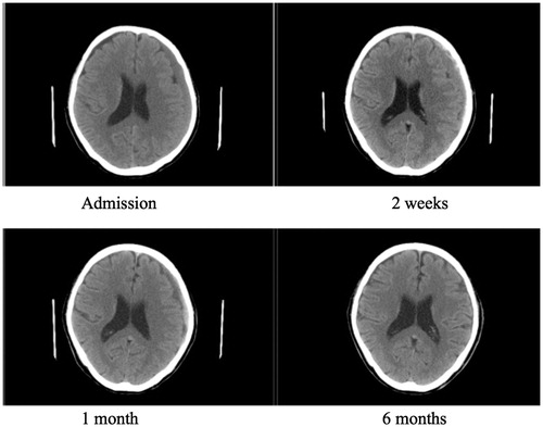 Figure 1. CT brain scan of a 79-year-old lady presented with poor memory.