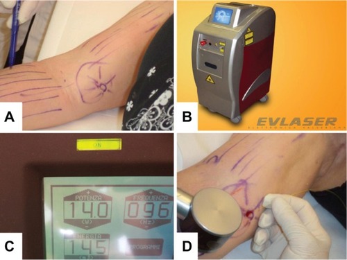 Figure 1 (A) Radial short tunnels along the right upper arm. (B and C) Nd:YAG laser device and operating settings. (D) Introduction of the fiber optic laser through an incision in the skin, along with the skin cooling system.