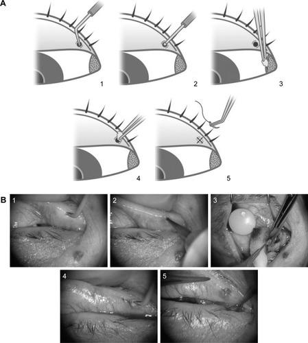 Figure 1 Surgical steps of our newly developed punctal occlusion method ([A]. schematic diagram, [B]. surgical photo).