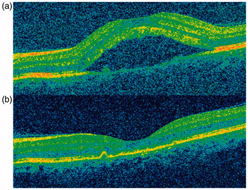 Figure 5. (a) OCT showing subretinal fluid before treatment and (b) OCT after 4 infusions of rituximab.