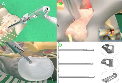 Figure 2 The schematic diagram of Endo-TLIF. (A) Working channel was placed on the superior articular process. (B) Foraminoplasty and laminectomy was achieved by trephine. (C) The lumbar disc was removed by special reamer. (D) The detail of three different reamers.