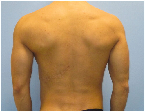 Figure 4. Post-operative result at 18-month follow-up in the posterior projection.