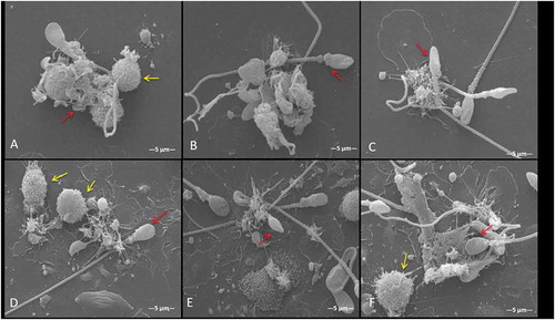 Figure 1. Human spermatozoa-induced monocyte extracellular trap (METs) visualized by scanning electron microscopy (SEM). Co-incubation of human monocytes with spermatozoa (aseptic conditions) (A–C) and spermatozoa-E. coli (septic conditions) (D–F) after 180 min exposure. Overview of the physical structure of METs composed of thin and thick nets that adhere and trap the spermatozoa, forming small sperm aggregates, producing alteration of the morphology mainly of the middle piece and spermatic tail (A–C). In the presence of E. coli (D–F), monocytes produce greater METs formation. Yellow arrows indicate monocytes and red arrows indicate spermatozoa being trapped by METs.