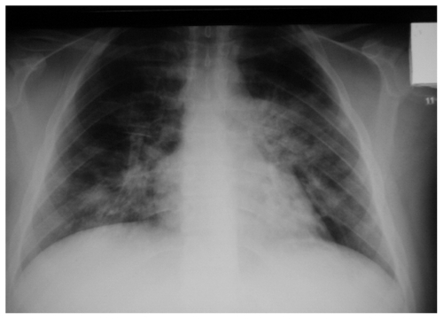 Figure 3 Chest X-ray after levofloxacin was added.