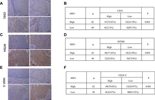 Figure 2 Increased MTDH, VEGF-C and CD31 expression in CTT and their co-relation with HSF1. (A) CD31 expression, (C) MTDH expression, (E) VEGF-C expression in CTT of different differentiated stages. Chi-square test of the expression co-relation between HSF1 and CD31 (B), HSF1 and MTDH (D), HSF1 and VEGF-C (F).