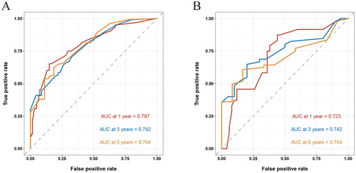 Figure 4. Receiver operating characteristic (ROC) curves of 1, 3, and 5-year in the training (A) and validation cohorts (B), respectively. The area under the ROC curve (AUC) was 0.797, 0.782, and 0.794 in the training cohort, and 0.723, 0.742, and 0.704 in the validation cohort, respectively.