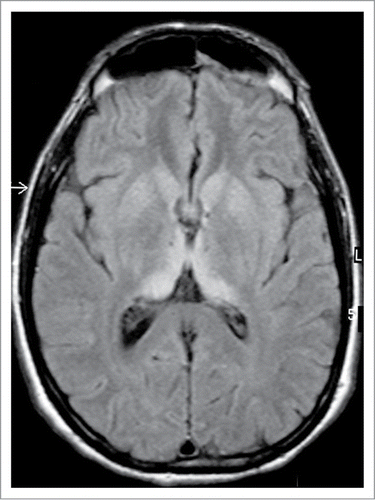 Figure 4. MRI brain scan in variant CJD. FLAIR axial section at the level of the basal ganglia showing bilateral symmetrical dorsomedial and pulvinar thalamic hyperintensity. Courtesy of Dr David Summers.