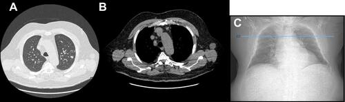 Figure 1 Chest CT scan of February 19, 2019 representing a left upper lobe pulmonary nodule of 12.4 mm in lung window (A) and a prevascular adenopathy in mediastinal window of 12.7 mm (B). Chest X-Ray with the cross-sectional height at which pulmonary nodule is located (C).