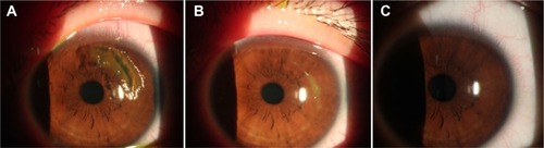 Figure 4 Corneal epithelial wound digital images of the HA group.