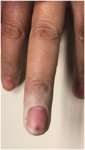 Figure 3. Skin discoloration in the distal third of the right middle finger (dorsal view).