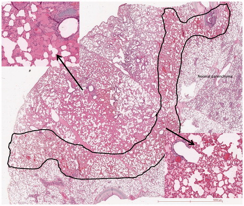 Figure 4. H&E staining. Concentric haemorrhagic modifications along the RFA needle. Left cartridge: centre with alveolar spaces filled by haemorrhagic fluid. Right cartridge: periphery with congestion of the capillaries.
