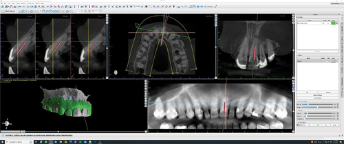 Figure 11. Placing and aligning the custom implant with the first entry point of the canal.